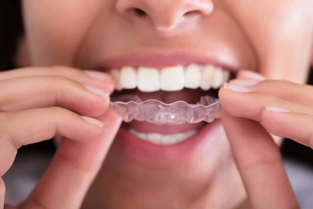 Woman placing a mouthguard in her mouth for teeth grinding