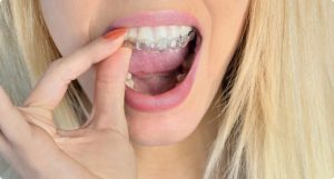 Woman with blonde hair placing a mouthguard in her mouth for teeth grinding